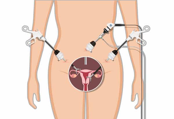 Laparoscopic Hysterectomy in Mumbai