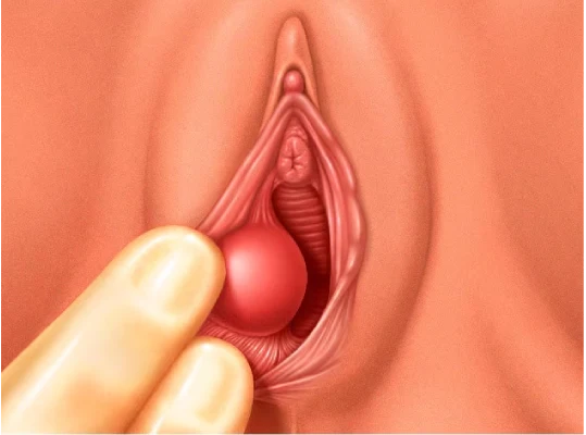 Bartholin Cyst treatment