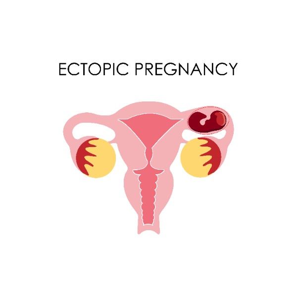 Ectopic-Pregnancy